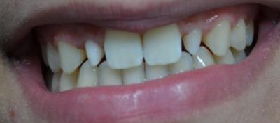facettes dentaires,Dentistes Paris 5 (75005)