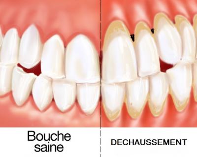 dechaussment des dents